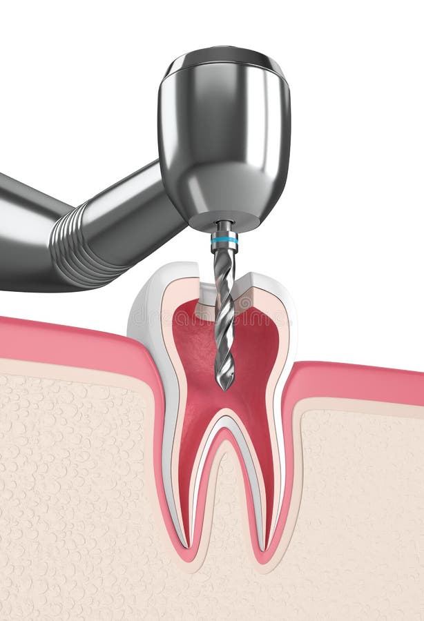 3d Render of Tooth in Gums with Dental Drill Stock Illustration Illustration of gingiva