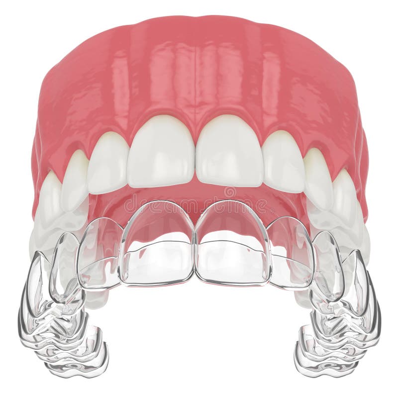 3d render of upper jaw with invisalign removable retainer royalty free illustration