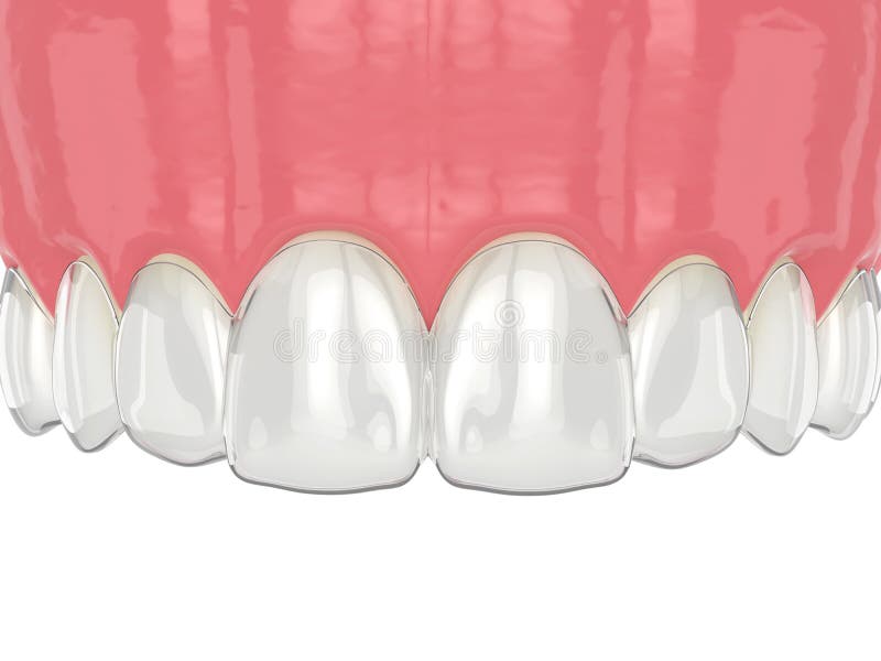 3d render of upper jaw with invisalign removable retainer stock illustration