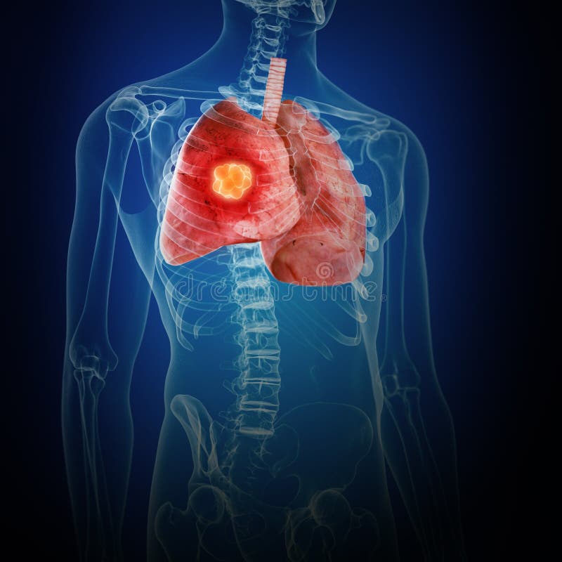 Lung cancer stock illustration. Illustration of bronchiolar 5564055