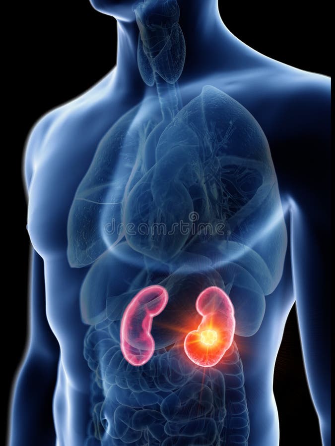 A mans kidneys tumor stock illustration. Illustration of rendering ...