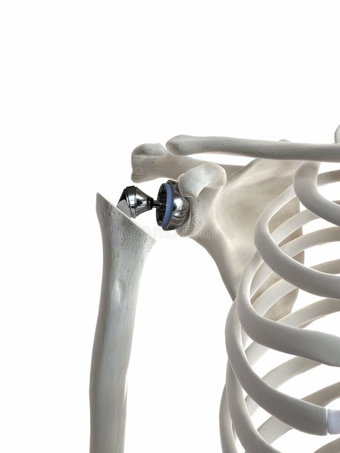A shoulder replacement stock illustration