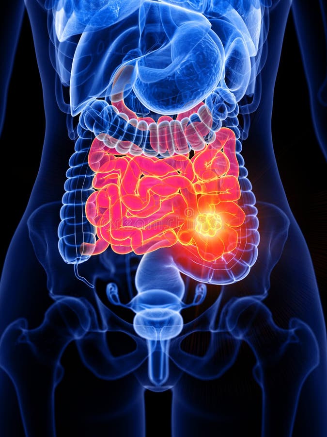 grapefruit size tumor on small intestine grapefruit size tumor on small intestine