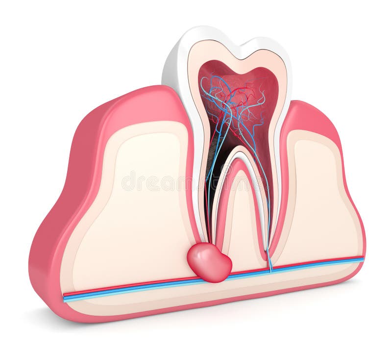 3d render of tooth in gums with cyst. Dental problem concept. 3d render of tooth in gums with cyst. Dental problem concept