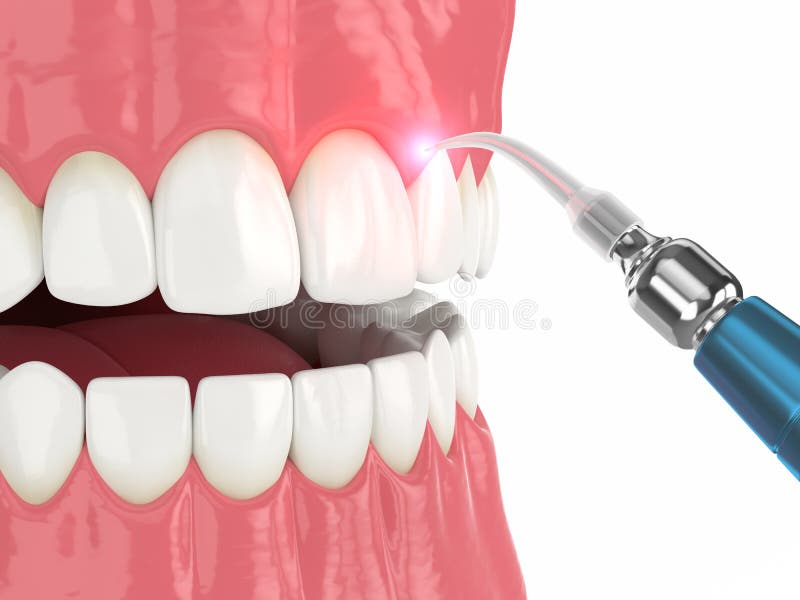 3d render of dental diode laser used to treat gums. The concept of using laser therapy in the treatment of gums. 3d render of dental diode laser used to treat gums. The concept of using laser therapy in the treatment of gums