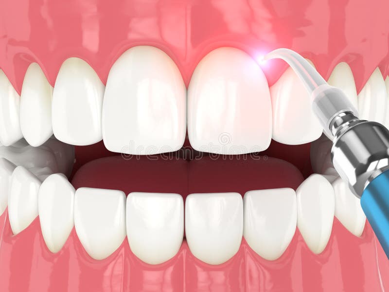 3d render of dental diode laser used to treat gums. The concept of using laser therapy in the treatment of gums. 3d render of dental diode laser used to treat gums. The concept of using laser therapy in the treatment of gums
