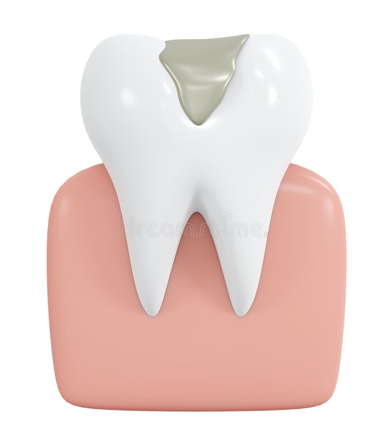 3D Rendering Tooth with Cavity and Titanium Filled Icon Cartoon Style