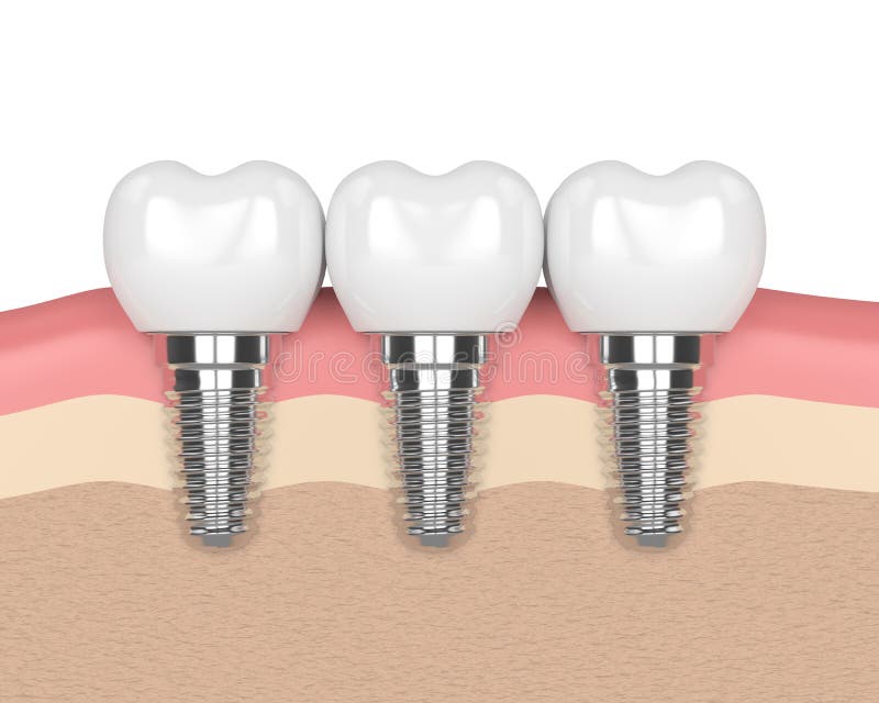 3d render of dental implants in gums over white background. 3d render of dental implants in gums over white background