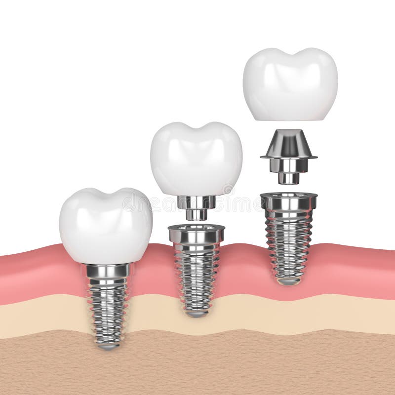 3d render of dental implants in gums over white background. 3d render of dental implants in gums over white background