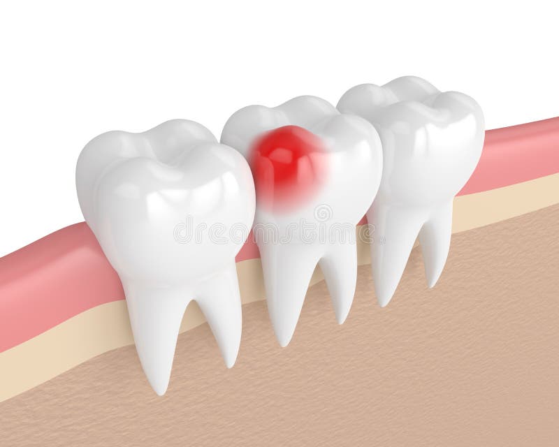 3d render of teeth with toothache in gums isolated over white background. 3d render of teeth with toothache in gums isolated over white background
