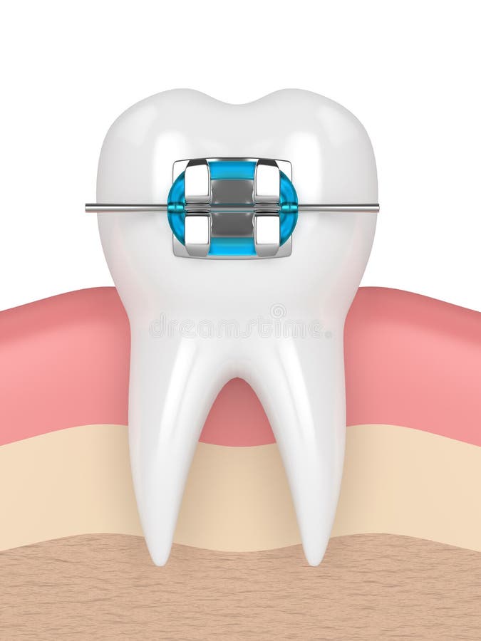 3d render of tooth with brace in gums over white background. 3d render of tooth with brace in gums over white background