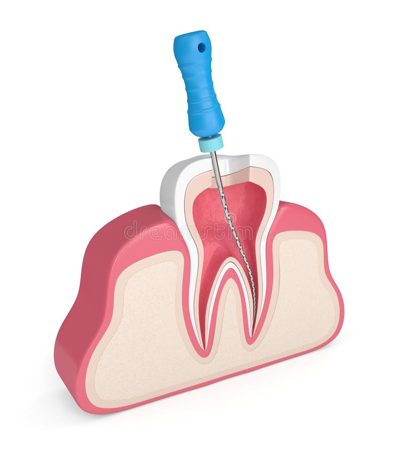 3d render of tooth with endodontic file in gums over white background. Root canal treatment concept. 3d render of tooth with endodontic file in gums over white background. Root canal treatment concept