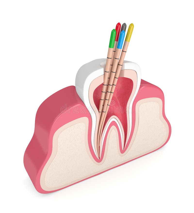 3d render of tooth in gums with gutta percha over white background. 3d render of tooth in gums with gutta percha over white background