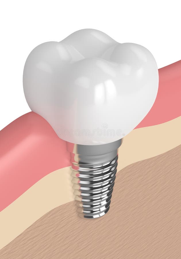 3d render of dental implant in gums isolated over white background. 3d render of dental implant in gums isolated over white background