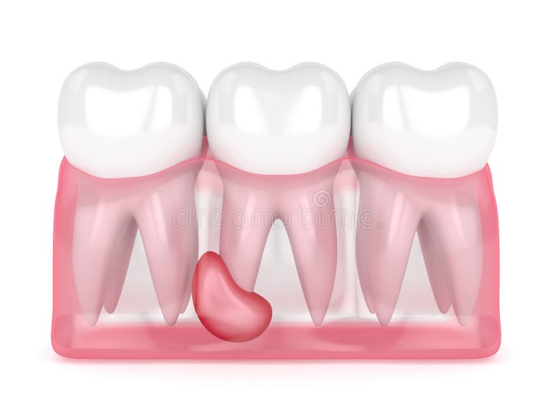3d render of teeth in gums with cyst over white background. Dental problem concept. 3d render of teeth in gums with cyst over white background. Dental problem concept