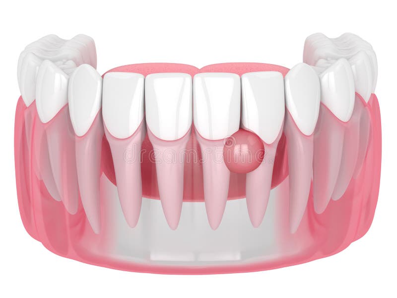 3d render of teeth in gums with cyst over white background. Dental problem concept. 3d render of teeth in gums with cyst over white background. Dental problem concept