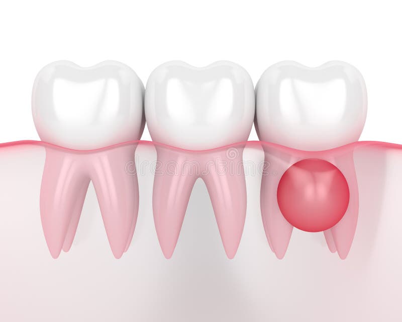 3d render of teeth in gums with cyst on root over white background. Dental problem concept. 3d render of teeth in gums with cyst on root over white background. Dental problem concept