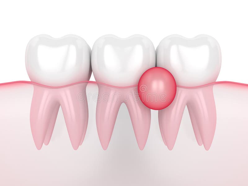 3d render of teeth in gums with cyst between crowns over white background. Dental problem concept. 3d render of teeth in gums with cyst between crowns over white background. Dental problem concept