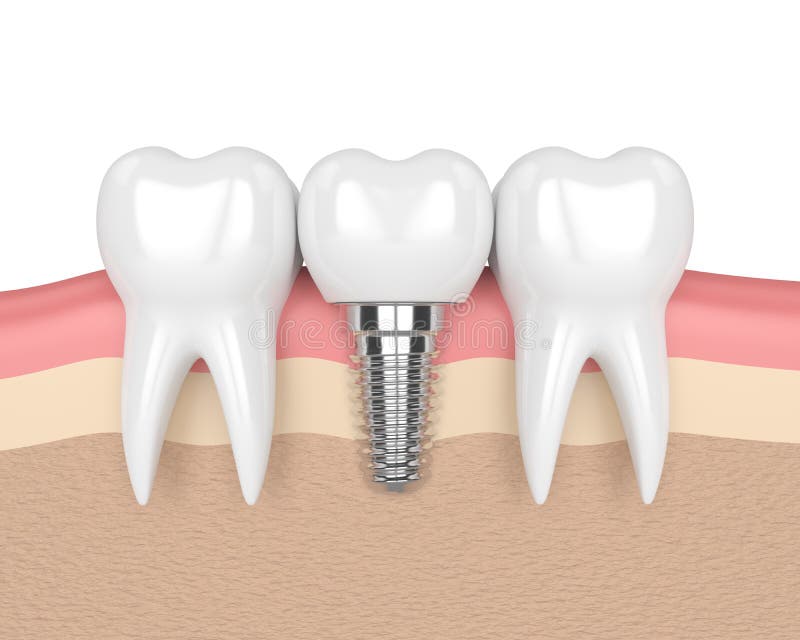 3d rinden de dientes con el implante dental en gomas ilustración del vector 3d rinden de dientes con el implante dental en gomas ilustración del vector