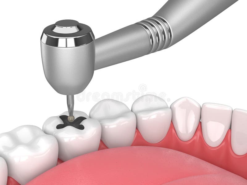 3d rinden de mandíbula con los dientes, el handpiece dental y el taladro libre illustration 3d rinden de mandíbula con los dientes, el handpiece dental y el taladro libre illustration