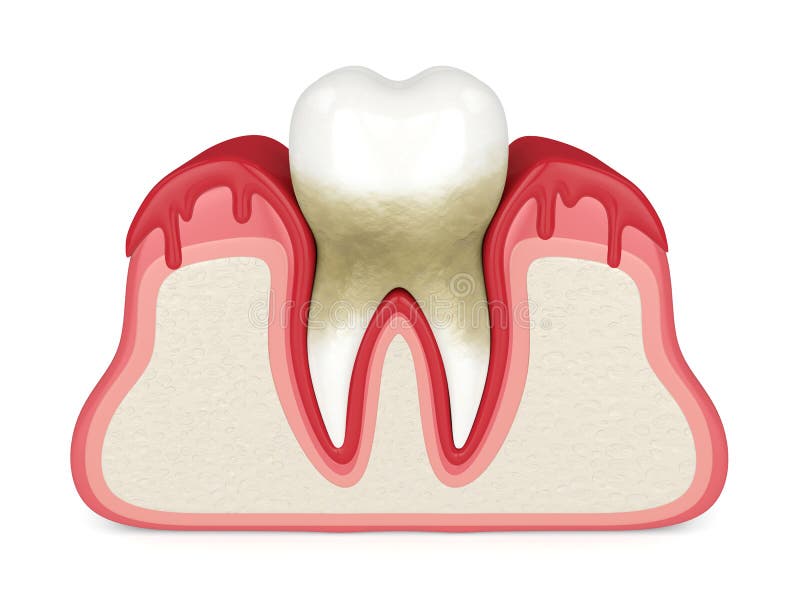 3d render of tooth in bleeding gums over white background. Periodontal disease concept. 3d render of tooth in bleeding gums over white background. Periodontal disease concept