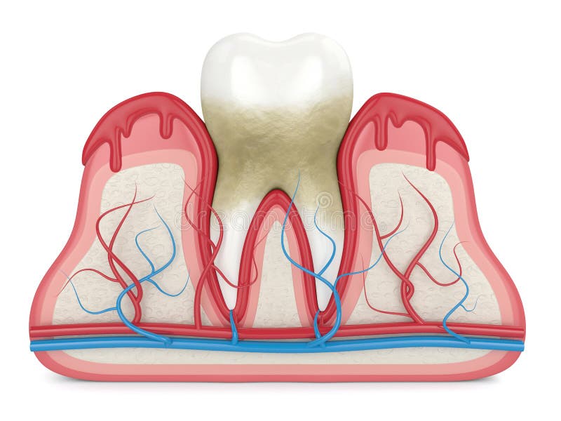 3d render of tooth in bleeding gums over white background. Periodontal disease concept. 3d render of tooth in bleeding gums over white background. Periodontal disease concept