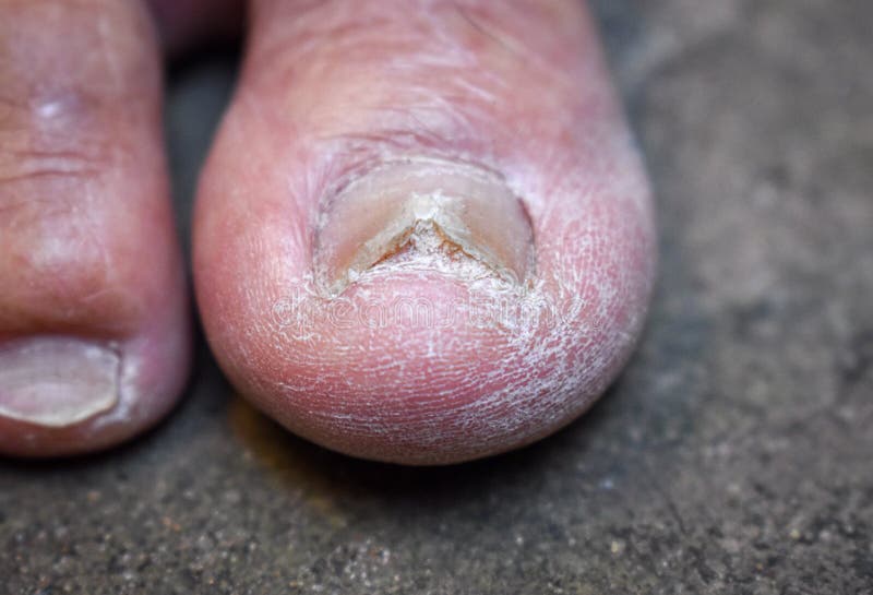 Fungal Nail Infection. Onychomycosis, Also Called Tinea Unguium