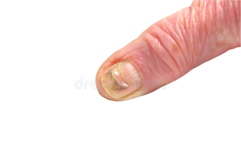 Damaged fingernail stock image. Image of hurt, care, nail 41251803