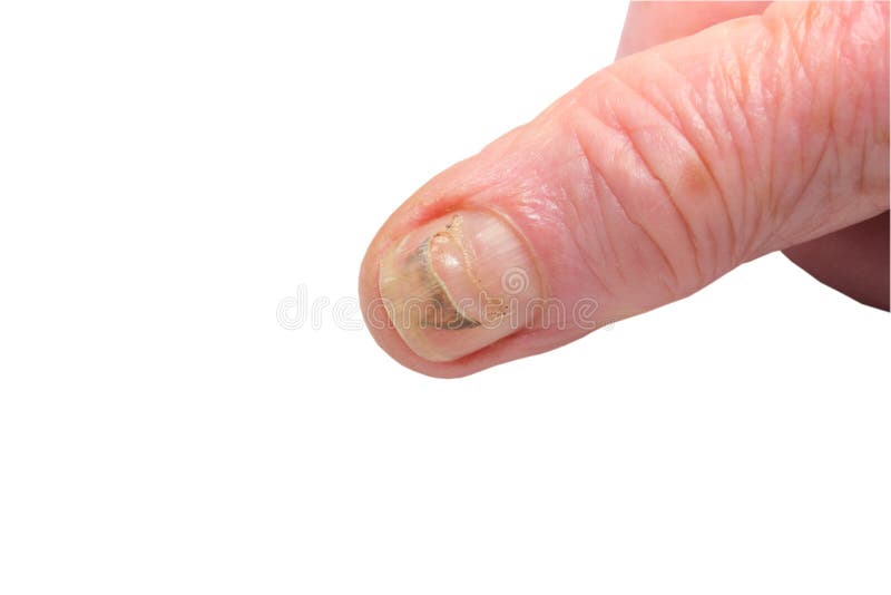 Damaged fingernail stock image. Image of fingernail, bruise 41251899