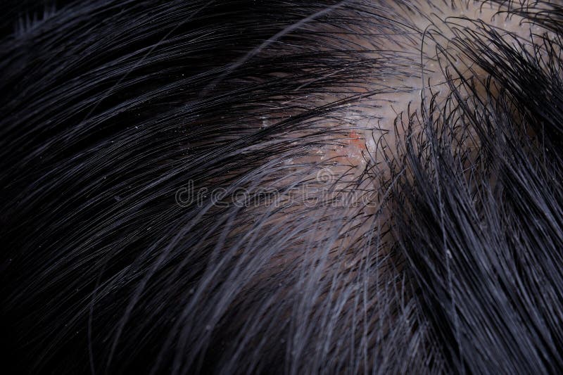 Dandruff stock photo. Image of dandruff, hair, problem - 33332712