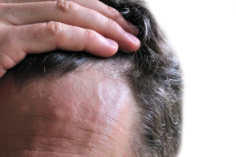 Dandruff skin issue stock photography Dandruff skin issue stock photography