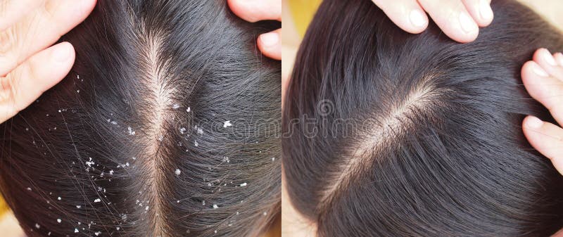 Before and after Dandruff Treatment Shampoo. Stock Photo - Image of sebum,  problem: 219998694