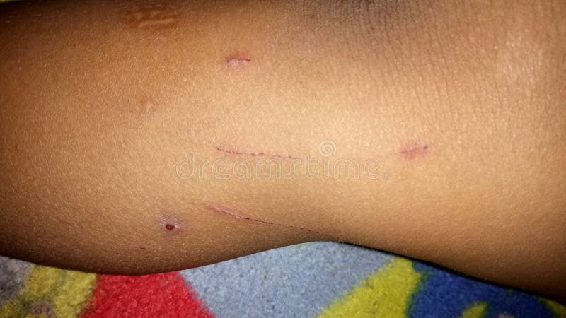 cat scratch