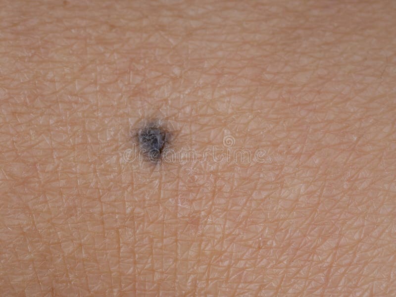 benign nevus