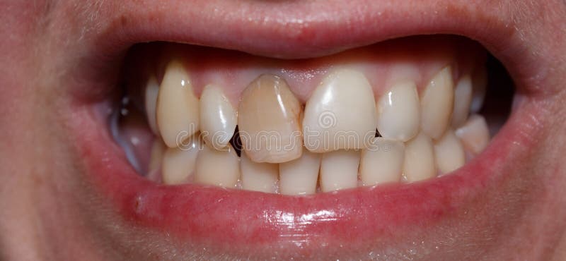 A Dark Front Tooth Protruding from the Tooth Row. Stock Photo - Image