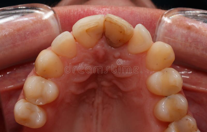 A Dark Front Tooth Protruding from the Tooth Row. a View of the Teeth