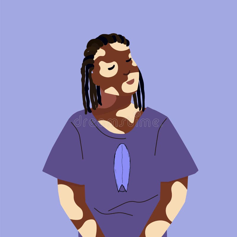 Dark Skinned Girl with Vitiligo and Deep Brown Dreadlocks. Vector ...