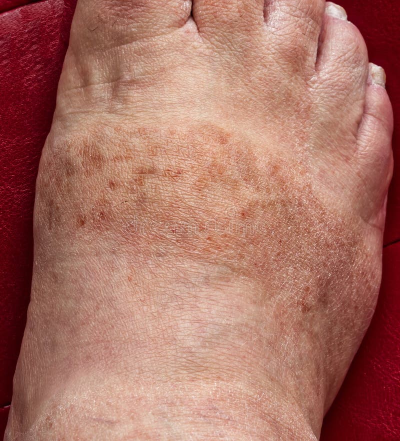 Dark Spots And Dehydrated Skin On Male`s Foot Dermatological Problems