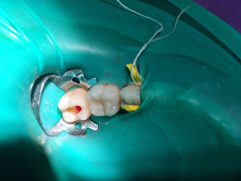 Das teilweise pulpotomy oder die Wurzelbehandlung in Kind-` s Molar t stockbild Das teilweise pulpotomy oder die Wurzelbehandlung in Kind-` s Molar t stockbild