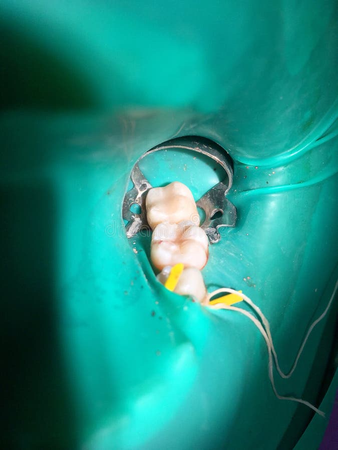 Das teilweise pulpotomy oder die Wurzelbehandlung in Kind-` s Molar t stockfotos Das teilweise pulpotomy oder die Wurzelbehandlung in Kind-` s Molar t stockfotos