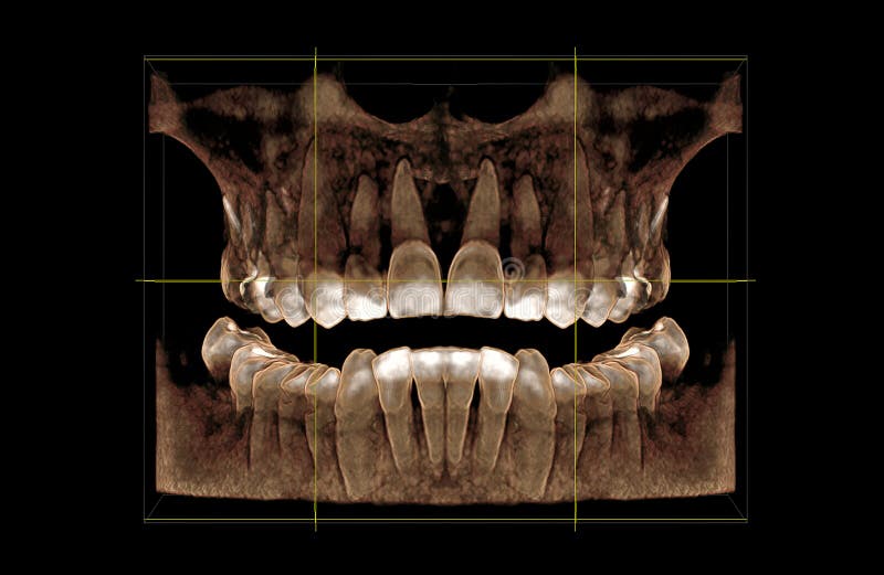 3D visualization of a computer tomogram of the dentition, front view. 3D visualization of a computer tomogram of the dentition, front view