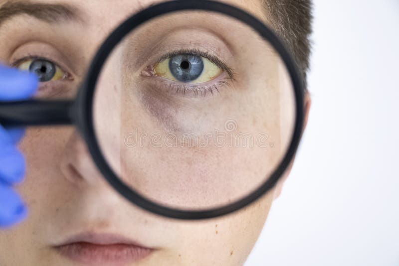 De Gele Kleur Van Het Mannelijke Oog Symptomen Van Geelzucht, Hepatitis of Problemen Met De