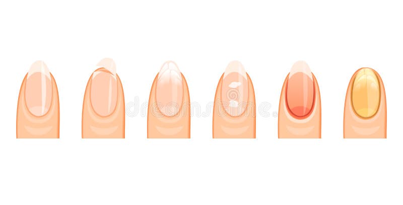 Illustration nails, damage, sickly, white background. Illustration nails, damage, sickly, white background