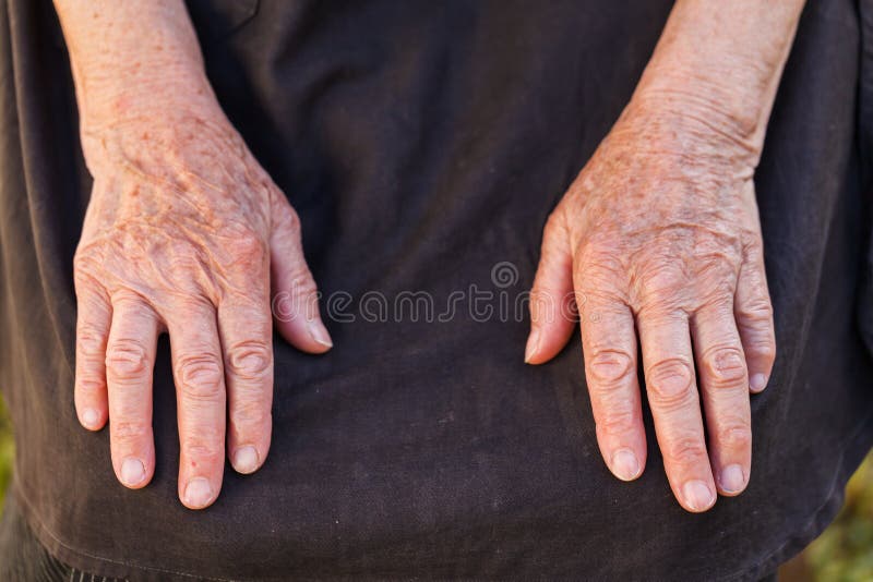 Elderly woman's hands suffering from articular disease. Elderly woman's hands suffering from articular disease