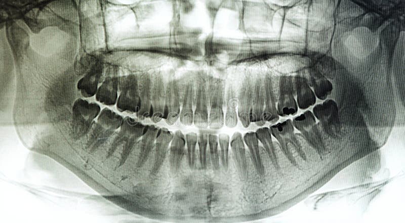 X-Ray scan human for teeth. X-Ray scan human for teeth