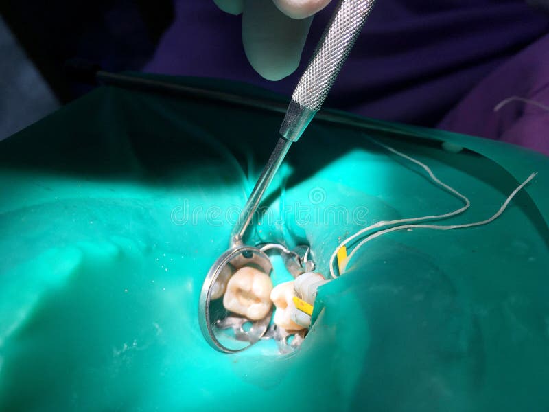 De partiska pulpotomy eller rotar kanalbehandling i kindtand t för barn` s royaltyfri foto De partiska pulpotomy eller rotar kanalbehandling i kindtand t för barn` s royaltyfri foto