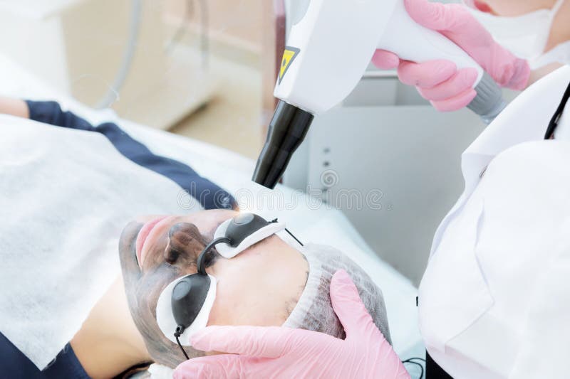 De procedure van de het gezichtsschil van de close-upkoolstof De laserimpulsen maken huid van het gezicht schoon De behandeling v royalty-vrije stock foto's De procedure van de het gezichtsschil van de close-upkoolstof De laserimpulsen maken huid van het gezicht schoon De behandeling v royalty-vrije stock foto's