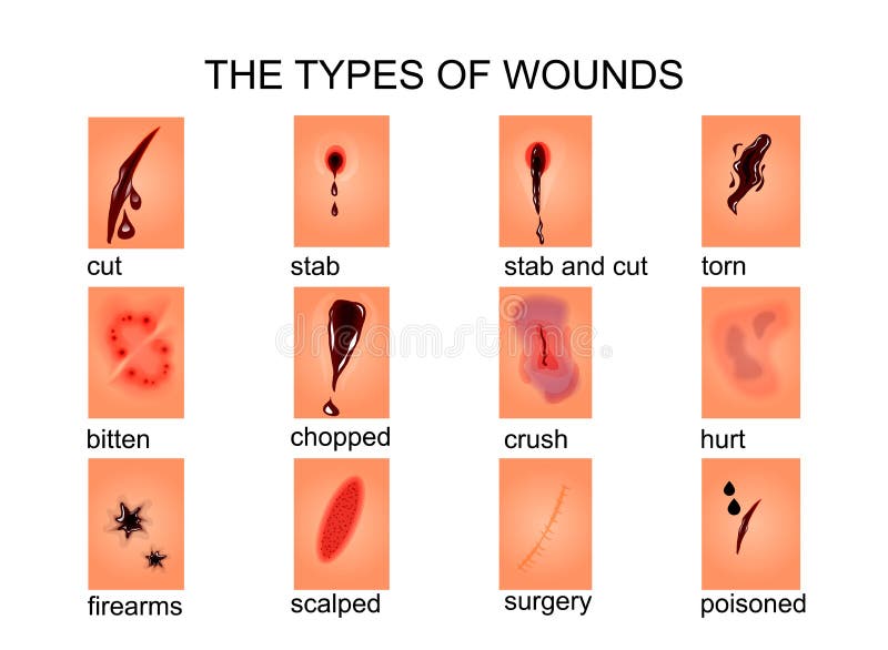 De Types Van Wonden Vector Illustratie Illustration Of Criminologie wound-man-human-outline-televised-suicide