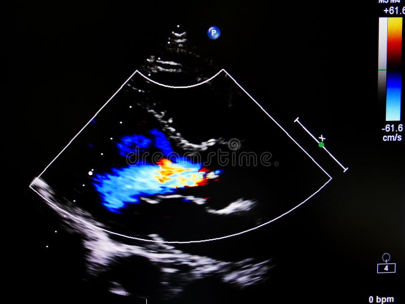 De wijze van de stroomkleur in echocardiogram royalty-vrije stock afbeeldingen De wijze van de stroomkleur in echocardiogram royalty-vrije stock afbeeldingen