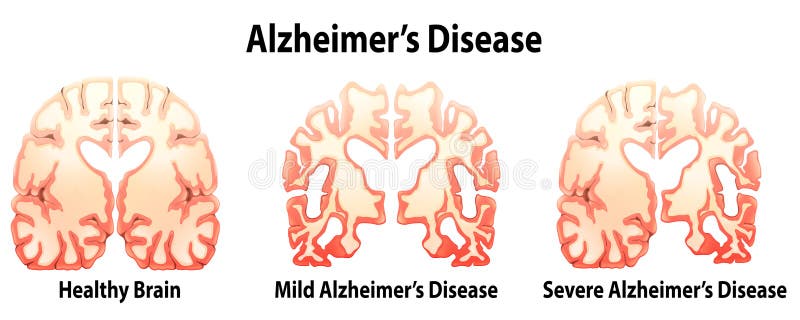 De Ziekte van Alzheimer stock illustratie. Illustratie bestaande uit